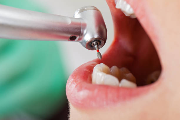 Best Emergency Root Canal Treatment in Greentown, IN